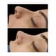 Slider image (7) The Nose Aesthetic Clinic